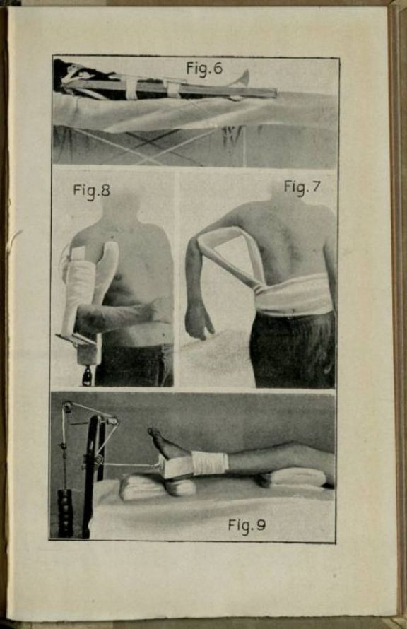 Il *trattamento delle fratture in guerra  / Vittorio Putti