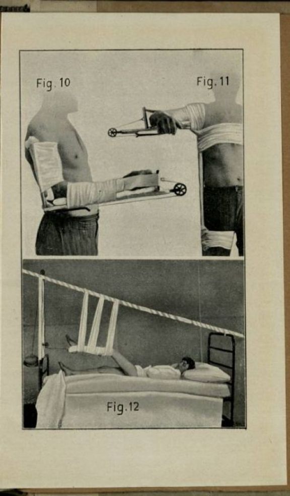 Il *trattamento delle fratture in guerra  / Vittorio Putti