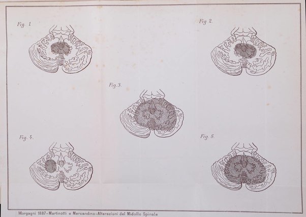 Il morgagni giornale indirizzato al progresso della medicina. Parte 1., Archivio o Memorie originali