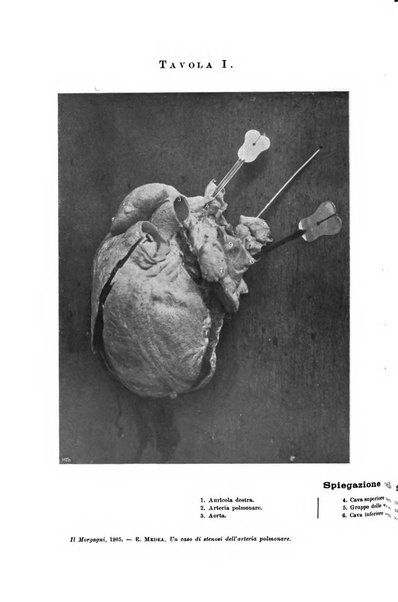 Il morgagni giornale indirizzato al progresso della medicina. Parte 1., Archivio o Memorie originali