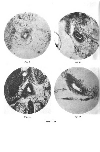 Il morgagni giornale indirizzato al progresso della medicina. Parte 1., Archivio o Memorie originali