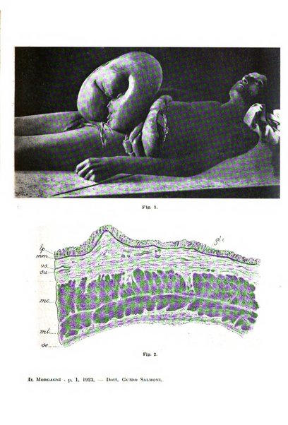 Il morgagni giornale indirizzato al progresso della medicina. Parte 1., Archivio o Memorie originali