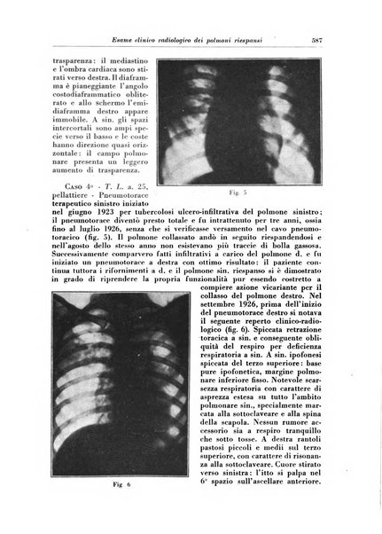 Rivista di patologia e clinica della tubercolosi organo ufficiale della Società italiana fascista di studi scientifici sulla tubercolosi