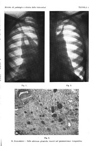 Rivista di patologia e clinica della tubercolosi organo ufficiale della Società italiana fascista di studi scientifici sulla tubercolosi