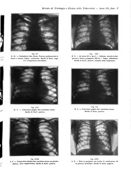 Rivista di patologia e clinica della tubercolosi organo ufficiale della Società italiana fascista di studi scientifici sulla tubercolosi