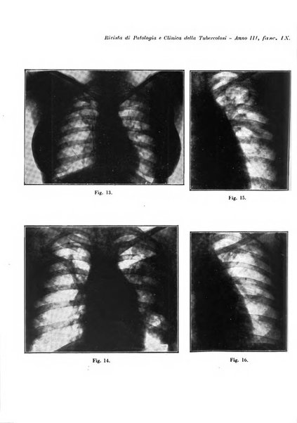 Rivista di patologia e clinica della tubercolosi organo ufficiale della Società italiana fascista di studi scientifici sulla tubercolosi