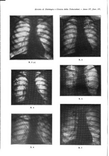 Rivista di patologia e clinica della tubercolosi organo ufficiale della Società italiana fascista di studi scientifici sulla tubercolosi