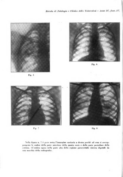 Rivista di patologia e clinica della tubercolosi organo ufficiale della Società italiana fascista di studi scientifici sulla tubercolosi