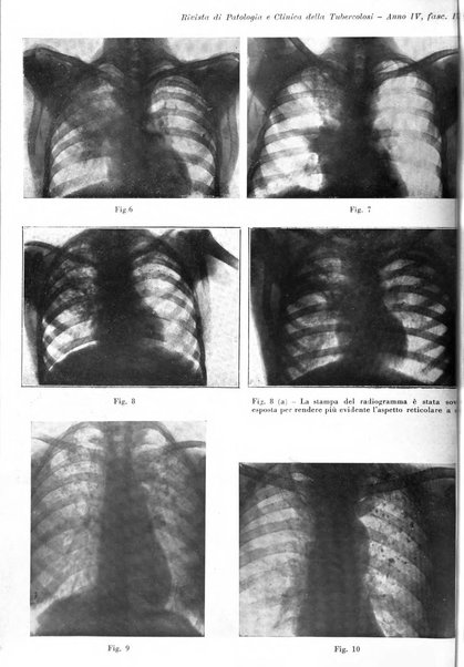 Rivista di patologia e clinica della tubercolosi organo ufficiale della Società italiana fascista di studi scientifici sulla tubercolosi