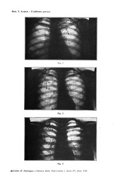 Rivista di patologia e clinica della tubercolosi organo ufficiale della Società italiana fascista di studi scientifici sulla tubercolosi