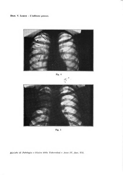 Rivista di patologia e clinica della tubercolosi organo ufficiale della Società italiana fascista di studi scientifici sulla tubercolosi