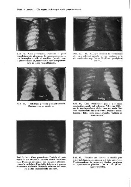 Rivista di patologia e clinica della tubercolosi organo ufficiale della Società italiana fascista di studi scientifici sulla tubercolosi