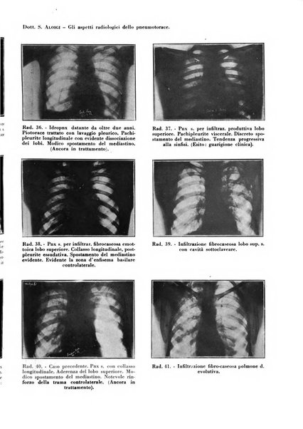 Rivista di patologia e clinica della tubercolosi organo ufficiale della Società italiana fascista di studi scientifici sulla tubercolosi