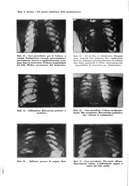 Rivista di patologia e clinica della tubercolosi organo ufficiale della Società italiana fascista di studi scientifici sulla tubercolosi