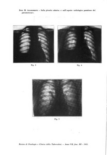 Rivista di patologia e clinica della tubercolosi organo ufficiale della Società italiana fascista di studi scientifici sulla tubercolosi