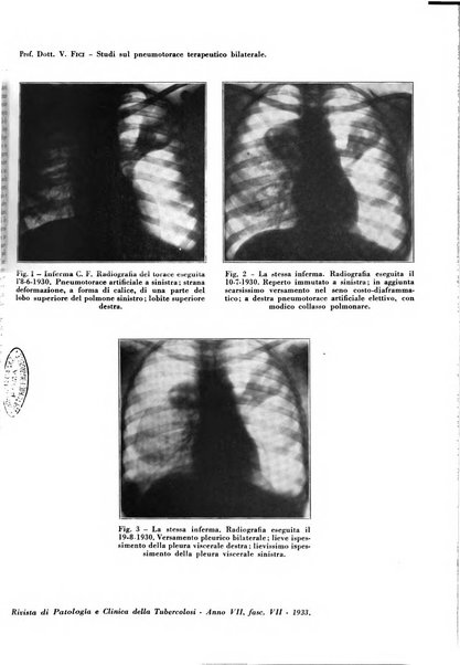 Rivista di patologia e clinica della tubercolosi organo ufficiale della Società italiana fascista di studi scientifici sulla tubercolosi