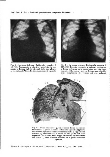 Rivista di patologia e clinica della tubercolosi organo ufficiale della Società italiana fascista di studi scientifici sulla tubercolosi