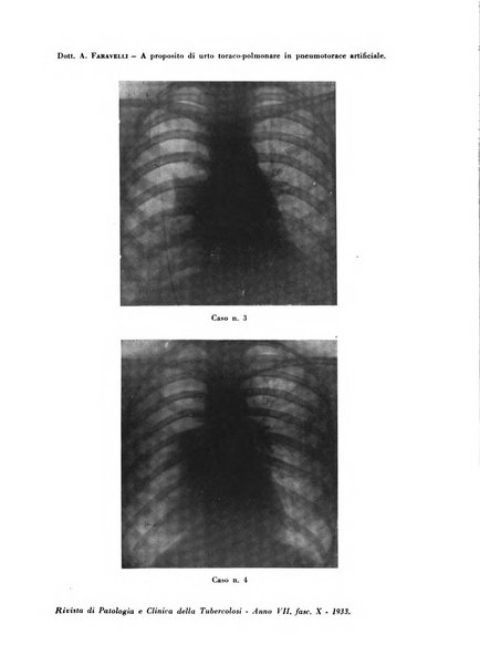 Rivista di patologia e clinica della tubercolosi organo ufficiale della Società italiana fascista di studi scientifici sulla tubercolosi