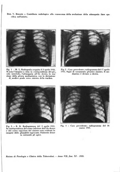 Rivista di patologia e clinica della tubercolosi organo ufficiale della Società italiana fascista di studi scientifici sulla tubercolosi