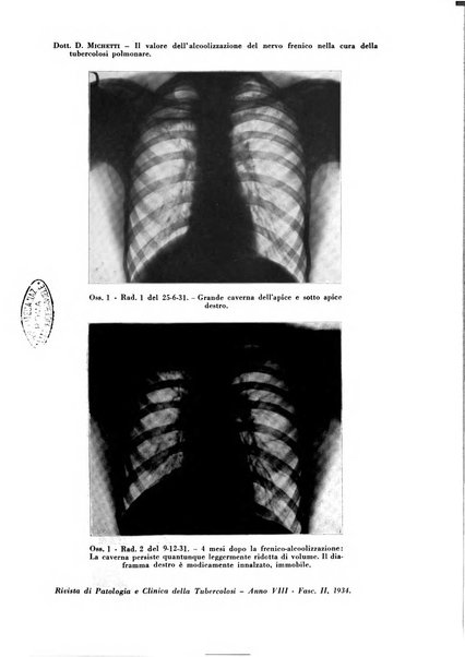 Rivista di patologia e clinica della tubercolosi organo ufficiale della Società italiana fascista di studi scientifici sulla tubercolosi