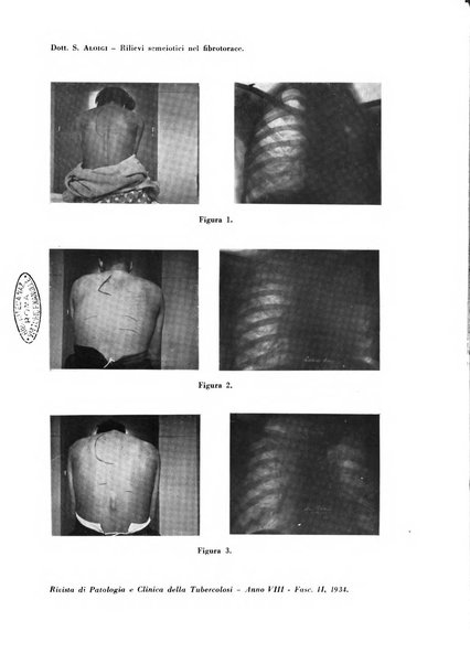 Rivista di patologia e clinica della tubercolosi organo ufficiale della Società italiana fascista di studi scientifici sulla tubercolosi