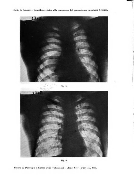 Rivista di patologia e clinica della tubercolosi organo ufficiale della Società italiana fascista di studi scientifici sulla tubercolosi