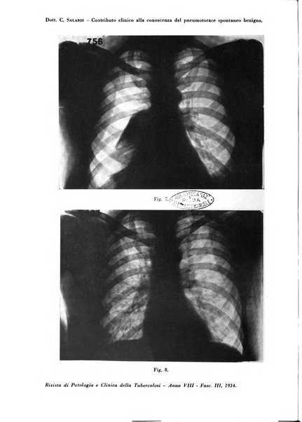 Rivista di patologia e clinica della tubercolosi organo ufficiale della Società italiana fascista di studi scientifici sulla tubercolosi