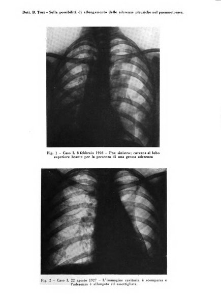 Rivista di patologia e clinica della tubercolosi organo ufficiale della Società italiana fascista di studi scientifici sulla tubercolosi