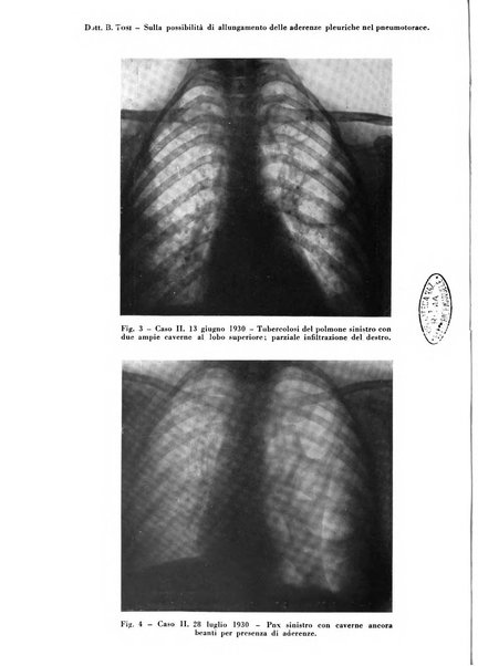 Rivista di patologia e clinica della tubercolosi organo ufficiale della Società italiana fascista di studi scientifici sulla tubercolosi