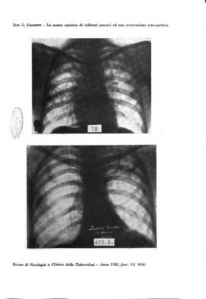 Rivista di patologia e clinica della tubercolosi organo ufficiale della Società italiana fascista di studi scientifici sulla tubercolosi