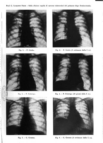 Rivista di patologia e clinica della tubercolosi organo ufficiale della Società italiana fascista di studi scientifici sulla tubercolosi