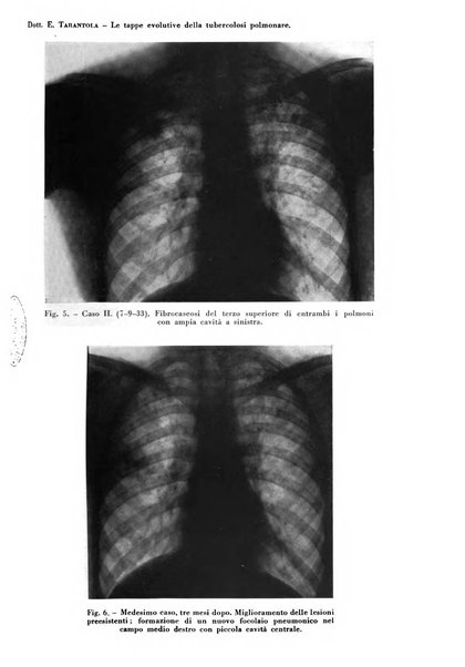 Rivista di patologia e clinica della tubercolosi organo ufficiale della Società italiana fascista di studi scientifici sulla tubercolosi