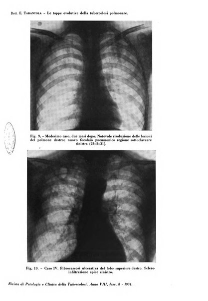 Rivista di patologia e clinica della tubercolosi organo ufficiale della Società italiana fascista di studi scientifici sulla tubercolosi