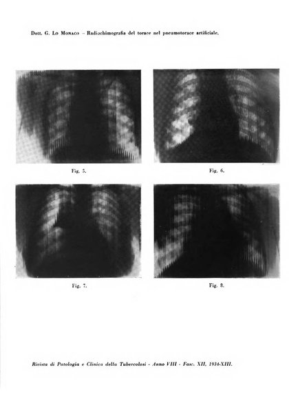 Rivista di patologia e clinica della tubercolosi organo ufficiale della Società italiana fascista di studi scientifici sulla tubercolosi