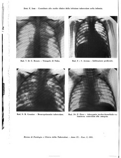 Rivista di patologia e clinica della tubercolosi organo ufficiale della Società italiana fascista di studi scientifici sulla tubercolosi