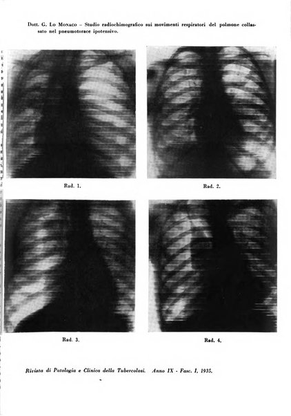 Rivista di patologia e clinica della tubercolosi organo ufficiale della Società italiana fascista di studi scientifici sulla tubercolosi