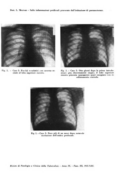 Rivista di patologia e clinica della tubercolosi organo ufficiale della Società italiana fascista di studi scientifici sulla tubercolosi