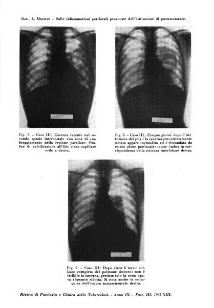 Rivista di patologia e clinica della tubercolosi organo ufficiale della Società italiana fascista di studi scientifici sulla tubercolosi