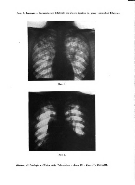 Rivista di patologia e clinica della tubercolosi organo ufficiale della Società italiana fascista di studi scientifici sulla tubercolosi