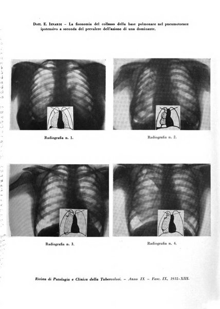 Rivista di patologia e clinica della tubercolosi organo ufficiale della Società italiana fascista di studi scientifici sulla tubercolosi