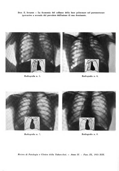 Rivista di patologia e clinica della tubercolosi organo ufficiale della Società italiana fascista di studi scientifici sulla tubercolosi