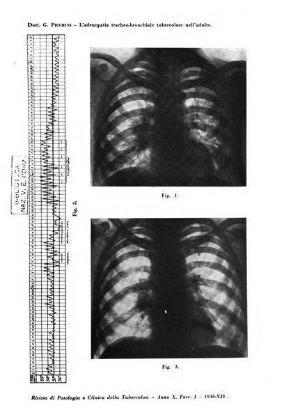 Rivista di patologia e clinica della tubercolosi organo ufficiale della Società italiana fascista di studi scientifici sulla tubercolosi