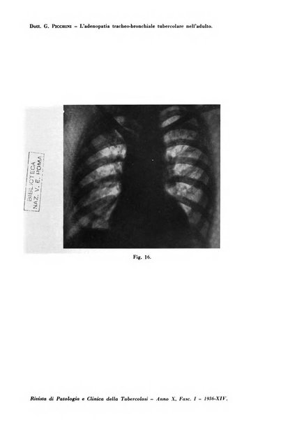 Rivista di patologia e clinica della tubercolosi organo ufficiale della Società italiana fascista di studi scientifici sulla tubercolosi