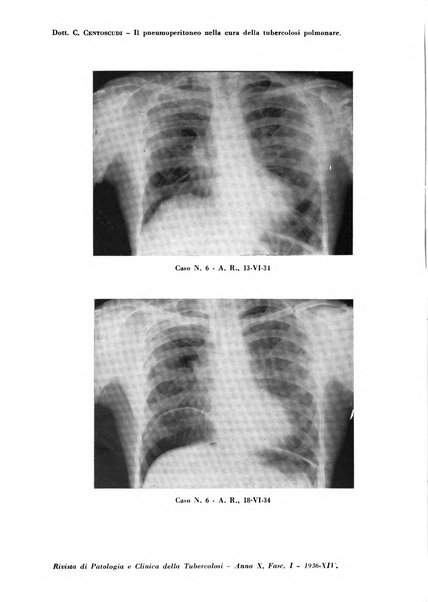 Rivista di patologia e clinica della tubercolosi organo ufficiale della Società italiana fascista di studi scientifici sulla tubercolosi