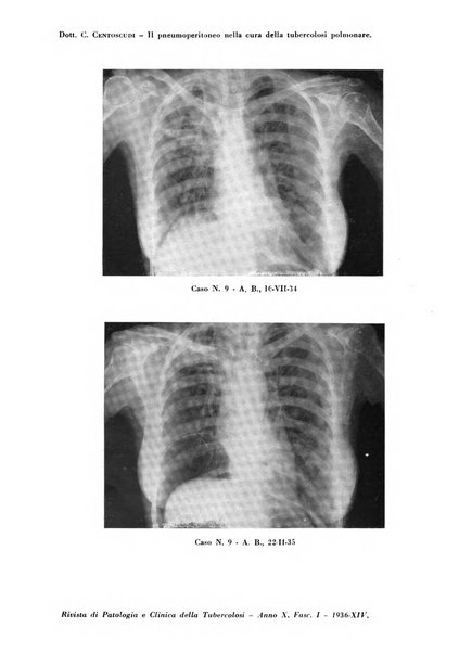 Rivista di patologia e clinica della tubercolosi organo ufficiale della Società italiana fascista di studi scientifici sulla tubercolosi