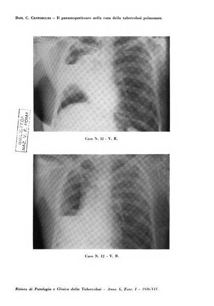 Rivista di patologia e clinica della tubercolosi organo ufficiale della Società italiana fascista di studi scientifici sulla tubercolosi