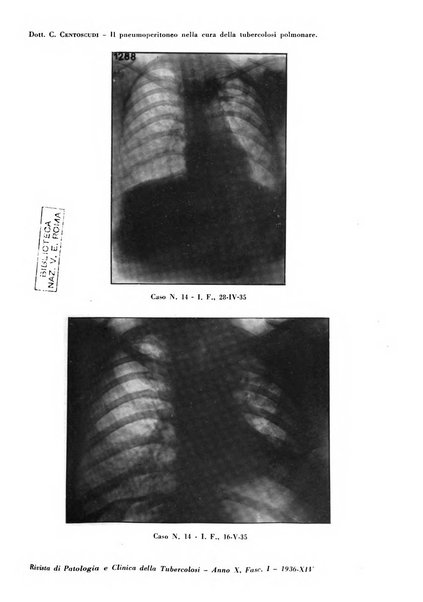 Rivista di patologia e clinica della tubercolosi organo ufficiale della Società italiana fascista di studi scientifici sulla tubercolosi