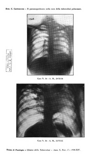 Rivista di patologia e clinica della tubercolosi organo ufficiale della Società italiana fascista di studi scientifici sulla tubercolosi