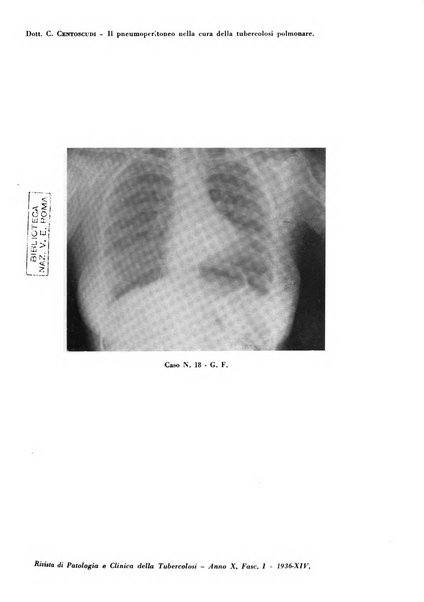 Rivista di patologia e clinica della tubercolosi organo ufficiale della Società italiana fascista di studi scientifici sulla tubercolosi