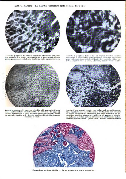 Rivista di patologia e clinica della tubercolosi organo ufficiale della Società italiana fascista di studi scientifici sulla tubercolosi